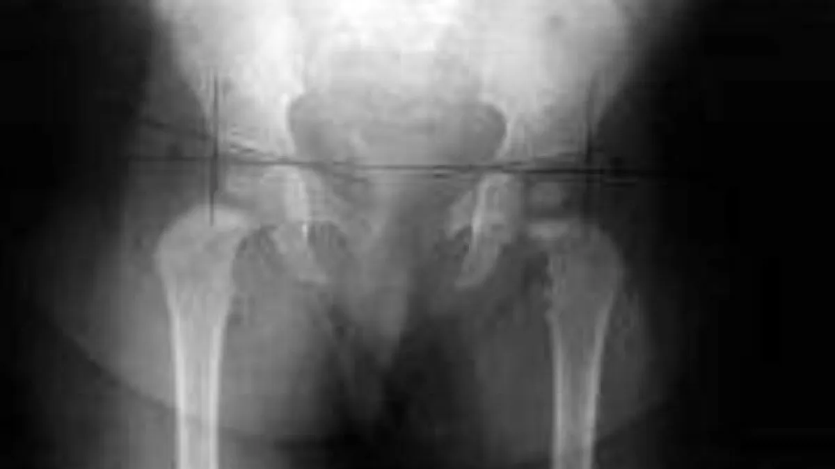 Justiça limita valor de cirurgia de R$ 239 mil cobrada do SUS